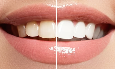 6 Kinds of Teeth Whitening