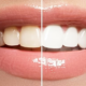 6 Kinds of Teeth Whitening