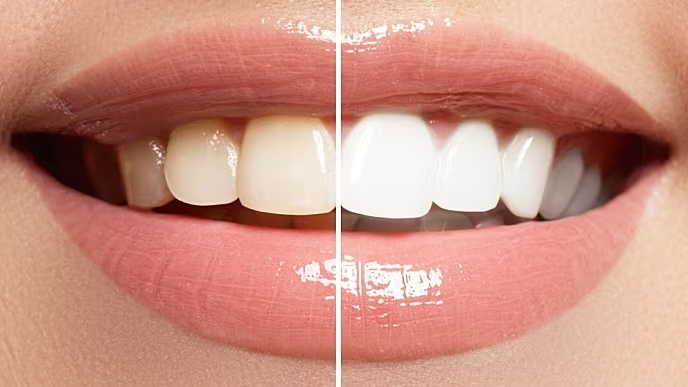 6 Kinds of Teeth Whitening