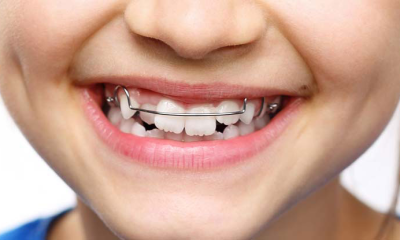 3 Types of Treatments for Misaligned Teeth