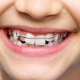 3 Types of Treatments for Misaligned Teeth