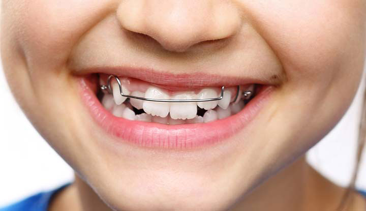 3 Types of Treatments for Misaligned Teeth